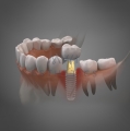 COWELLMEDI_INNO_Fixture_Dental_Implant